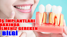 Diş İmplantları Hakkında Bilmeniz Gereken 9 Bilgi